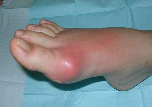 Clinical picture of arthritis in the feet - swelling and inflammation