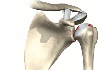 Shoulder joint affected by osteoarthritis