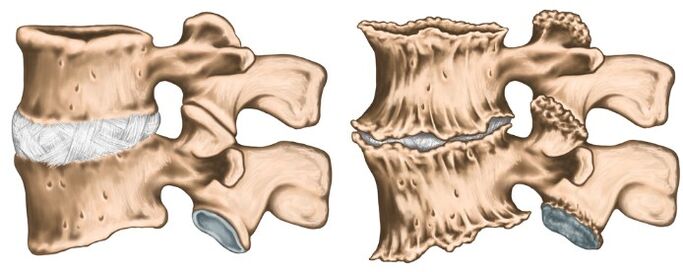 Healthy and destroyed articulation