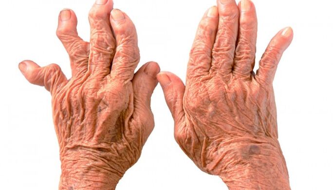 rheumatoid arthritis as a cause of finger joint pain