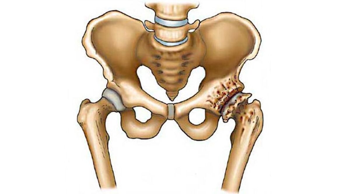 damage to the hip joint in the presence of arthrosis