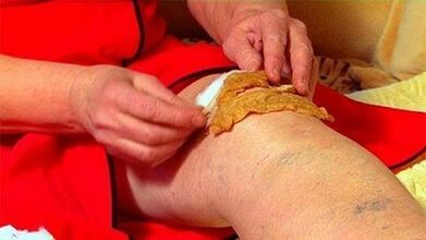 Knee articulation arthrosis
