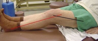 Progressive arthrosis of knee articulation