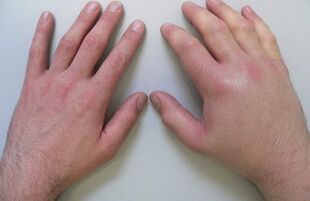 arthralgia as a cause of pain in finger joints