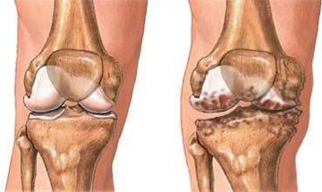 Knee arthrosis