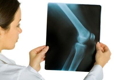 Treatment of knee articulation arthrosis