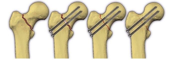 bone body fixation with pins for hip joint pain