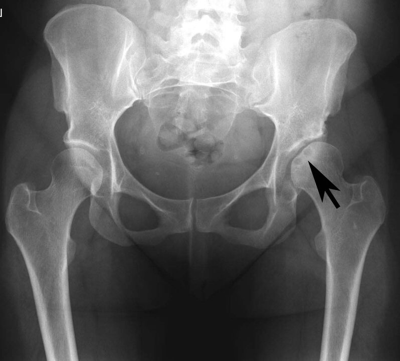 Deposition of calcium salts in the hip joint with pseudogout on x-ray